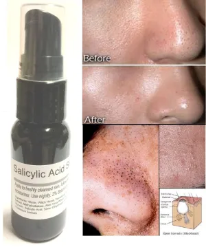 Salicylic Acid Serum 2% By ModelSupplies Eradicate Blackheads Clogged Pores Acne