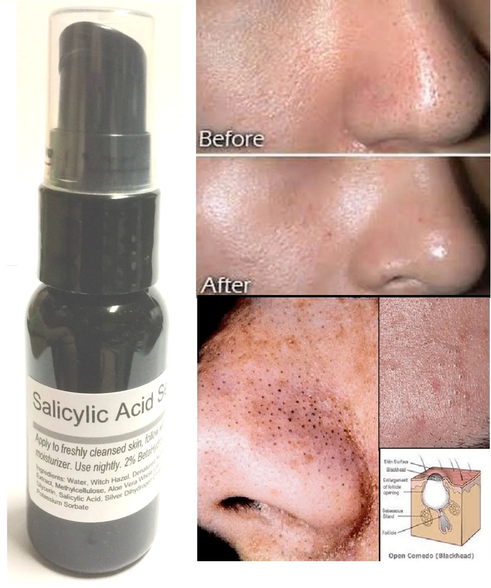 Salicylic Acid Serum 2% By ModelSupplies Eradicate Blackheads Clogged Pores Acne